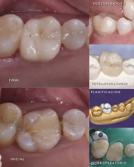 Antes y después: incrustaciones cerámicas