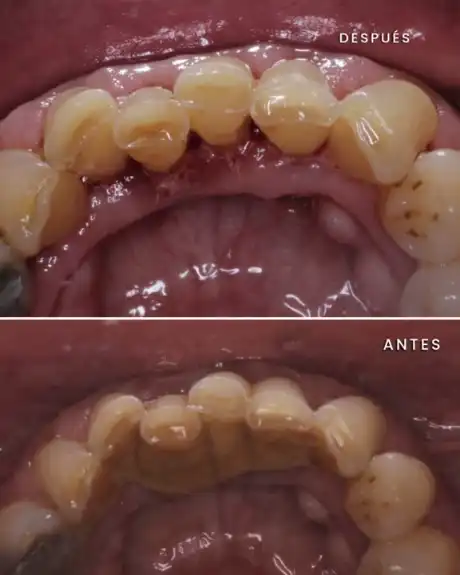 Antes y después: limpieza con ultrasonido